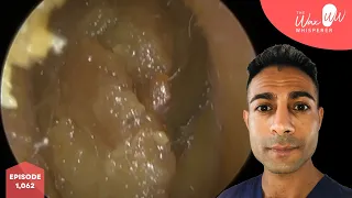 1,062 - Dizzy Patient Ear Wax Removal