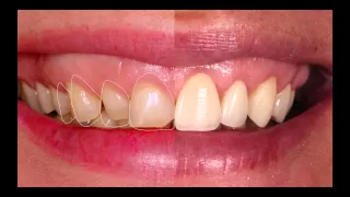 Smile Design | Crown Lengthening | Ceramic Veneers