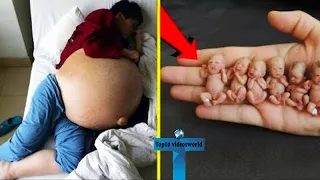 Top 10 Truly Unusual Childbirth Which Even Doctors Did Not Believe Changed Medical History