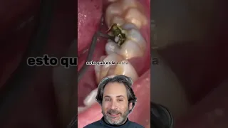 ¿Tienes una caries profunda en una muela? Mira todo lo que puede esconder (¡SOLUCIÓNALO YA!)