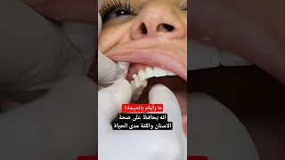 تركيب اسنان وجسور زيركون بعد ترميم كامل الاسنان والنتيجة ابتسامة جميلة صحية