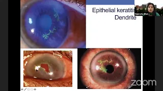 Corneal Infections: Beating the Bugs- Dr. Namrata Sharma