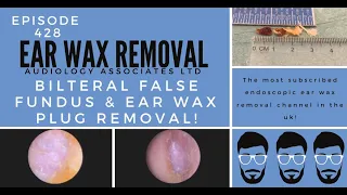 BILATERAL FALSE FUNDUS & EAR WAX PLUG REMOVAL - EP428