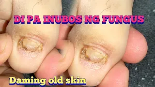overgrown infected ingrown toenail removal, With a super surprise 😱😍