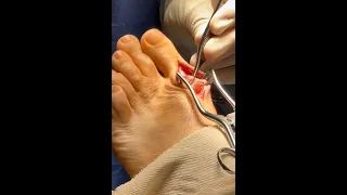 Bilateral Excision - Tailor's Bunion, Midfoot Fusion, Bunionectomy