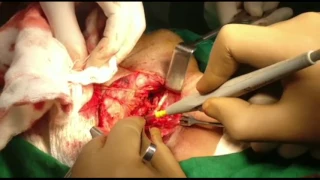 Parapharyngeal tumor excision - Dr. Deepak dalmia