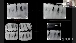 Flemiclav webinar