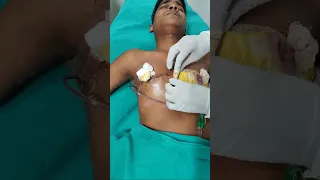 Double Incision FTM top surgery result