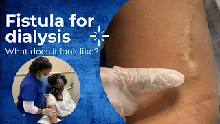 What does a fistula for dialysis look like? [CHT CERTIFICATION REVIEW] 2022