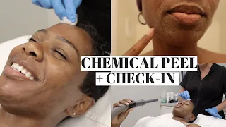 CHEMICAL PEEL| Full Process & Results!