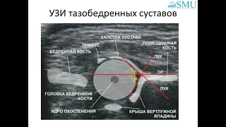 Дисплазия тазобедренного сустава