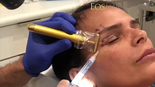 Solution for Hooded Eyelids: Upper Eyelid Procedure