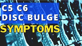 What Are The Symptoms Of A Bulging Disc In The Neck? C5 C6 Disc Bulge Symptoms? | Dr Walter Salubro