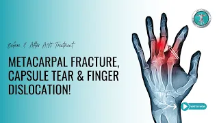 Metacarpal Fracture, Capsule Tear & Finger Dislocation : Before & After ANF Treatment