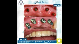 فديو يوضح عملية زراعة الاسنان