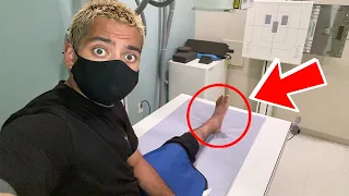 I BROKE MY ANKLE!!!