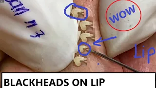 REMOVAL BLACKHEADS ON LIP AND FACE  (n7)  | LOAN NGUYEN