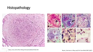 Sarcoidosis