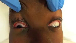 Inferior rectus entrapment