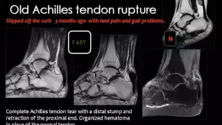 Imaging of Ankle joint Mar 2014   Dr Mamdouh Mahfouz In Arabic