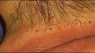 WOOW !! BEAUTY OF SQUEEZE😨 BLACKHEADS REMOVAL FROM THE LIPS #relaxing  #blackheads