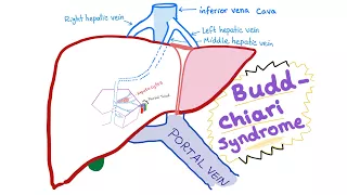 Budd-Chiari syndrome (Definition, causes, pathophysiology, Diagnosis & Treatment)