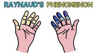 RAYNAUDS SYNDROME | CAUSE, APPEARANCE, DIAGNOSIS AND TREATMENT - RAYNAUDS PHENOMENON