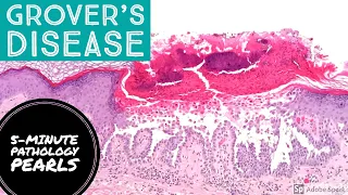 Grover's Disease (Transient Acantholytic Dermatosis): 5-Minute Pathology Pearls