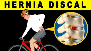 😧¿ES BUENO PEDALEAR CON HERNIA DISCAL? (PUEDE QUE TENGAS UNA Y NO LO SEPAS)🚲 SALUD CICLISTA