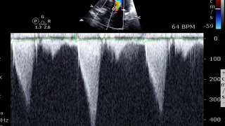 HCM with LVOT OBS and SAM