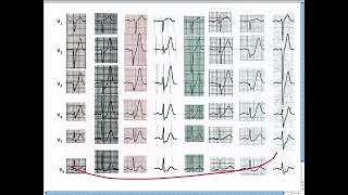 Amal Mattu's ECG Case of the Week_ Nov 11, 2013