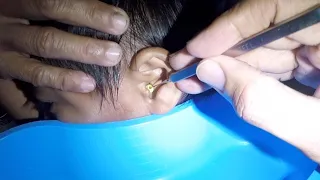 Removing Something STUCK Inside Boy's Ear | It's Clogged!