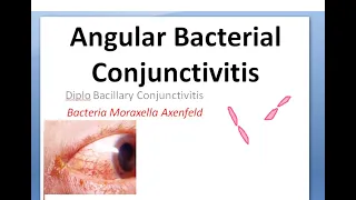 Ophthalmology 075 a Angular Bacterial Conjuntivitis Diplo Bacillary Moraxella Axenfeld angle foamy