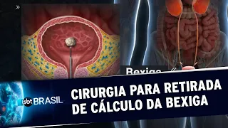 Brasil realiza apenas 150 cirurgias para retirada de pedra na bexiga por ano | SBT Brasil (25/09/20)