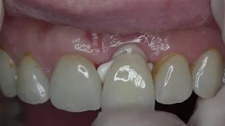 Cementation: Glass ionomer cements
