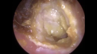 194: Eardrum about to 'EXPLODE' after Blocked Ear Wax Removal using Endoscopic Ear Microsuction