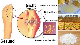 Wie man den Harnsäurespiegel natürlich senkt!