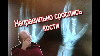 Неправильно срослась кость, как я решал задачу. 👊 bone not growing properly