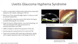 Lecture: Uveitis-Glaucoma-Hyphema Syndrome (1 Slide in 5 Minutes)