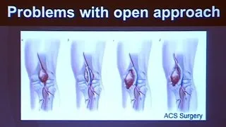 Outcomes for Endovascular Treatment of Popliteal Aneurysms are Similar to Open Repair