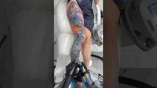 Удаляем полностью со всей ноги татуировку лазером в клинике Sokolov Laser