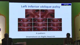 AIOC2020 GP018 T3 Prof Rohit Saxena  Brown' s Syndrome