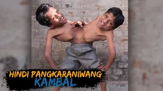 10 Hindi Pangkaraniwang kambal na ikakagulat mo | Pinaka kakaibang kambal na nabubuhay