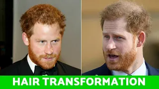 Prince Harry's Hair Transformation: Rapid balding after marrying Meghan, Hair Transplant?