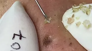 Pimple and Blackhead Extractions Gone Wrong