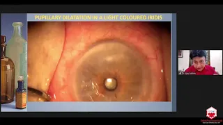 Dr. Ajay Mehta: Intraoperative pupillary dilatation (ROS Webinar 10th Oct '20)