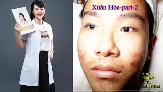 Get rid of the various of acnes at hien van spa-part 2|342|Xuân Hòa