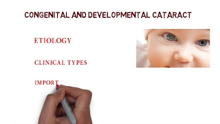 CONGENITAL CATARACT |  LECTURE PG NOTES