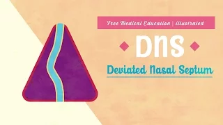 What is Deviated Nasal Septum (DNS)?