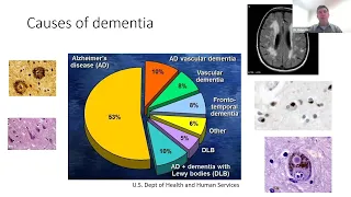 The Other Dementias A Look Under the Dementia Umbrella